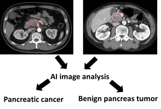 Improving Detection and Characterization of Pancreatic Masses through AI-assisted Imaging Processing